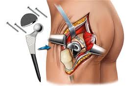 Hip Replacement surgery in Delhi