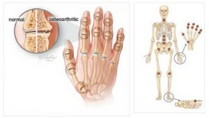 Osteoarthritis - Dwarka Orthopaedic Centre