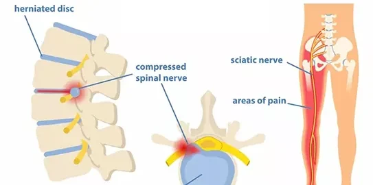  "Sciatica Treatment near Palam" – Trusted Spine Specialist near Dwarka