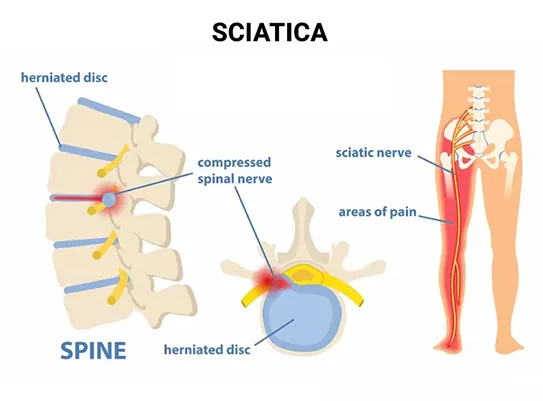  "Sciatica Treatment near Palam" – Trusted Spine Specialist near Dwarka