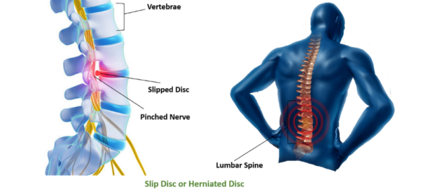 "Slip Disc Treatment near Palam"